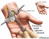 carpal tunnel syndrome